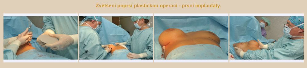Zvětšení poprsí plastickou operací - prsní implantáty